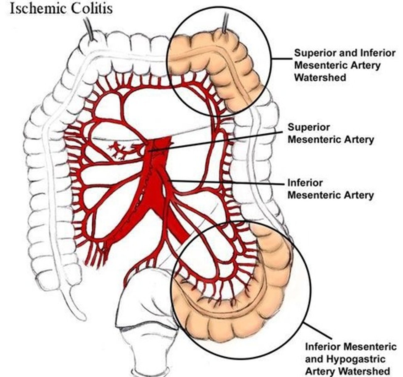<p>Ischemic colitis</p><p>- Splenic flexure most common (supplied by end arteries)</p><p>- vulnerable to ischemia during systemic hypotension in "water-shed" areas</p><p>- X-ray show "thumb printing"</p>