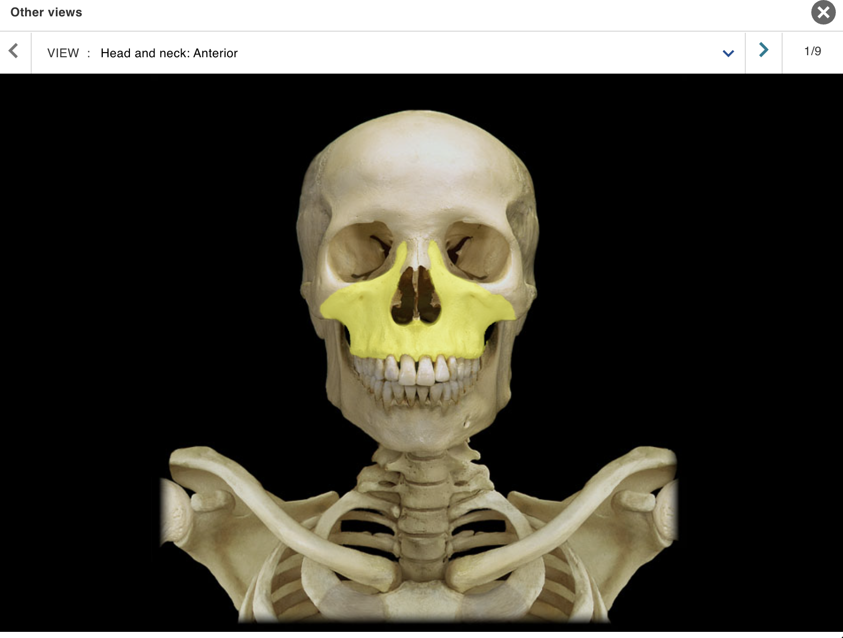 <p>Location:</p><p class="p1">• Skull (anterior)</p><p class="p1">Description:</p><ul><li><p>﻿﻿Paired, irregular-shaped bone</p></li><li><p>﻿﻿Left and right maxillae unite to form "upper jaw"</p></li><li><p>﻿﻿Contains alveoli ("sockets") for teeth</p></li><li><p>﻿﻿Contains maxillary air sinus on each side</p></li></ul><p class="p1">Also known as:</p><p class="p1">• "Upper jaw"</p><p class="p1">Comment:</p><ul><li><p>﻿﻿Forms part of floor of orbit and anterior part of hard palate</p></li><li><p>﻿﻿Contributes to upper face</p></li></ul><p></p>