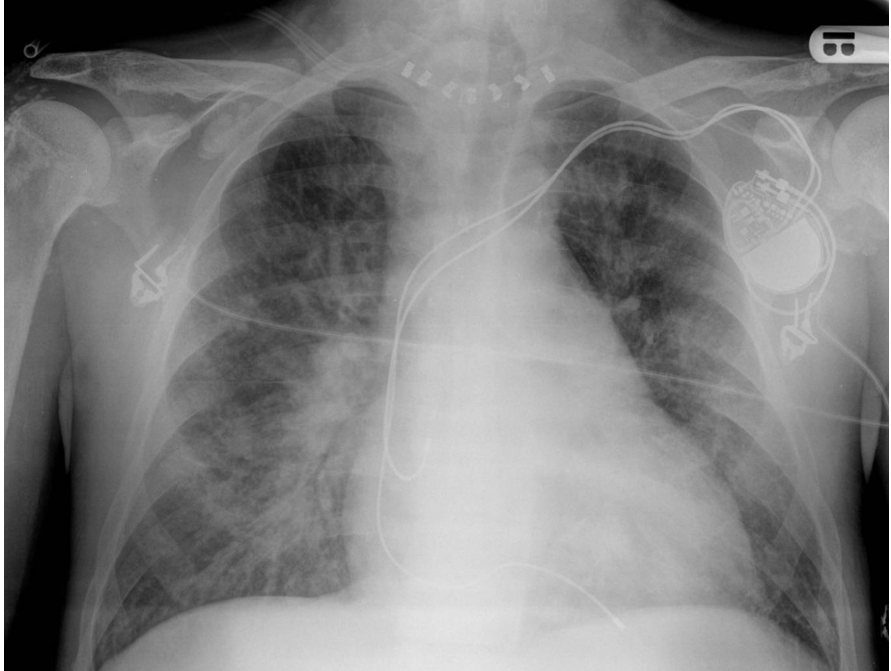 <p>Patient history: postoperative condition (thyreoidectomy) </p><p>Modality: AP (prone) chest radiograph </p><p>Region: chest, lungs Radiologic sign: Cephalisation, bilateral perihilar consolidation and cardiomegaly (CTI > 0.5). Foreign bodies: pacemaker device and electrodes, surgical clips following thyroid surgery, ECG </p><p>Diagnosis: pulmonary edema</p>