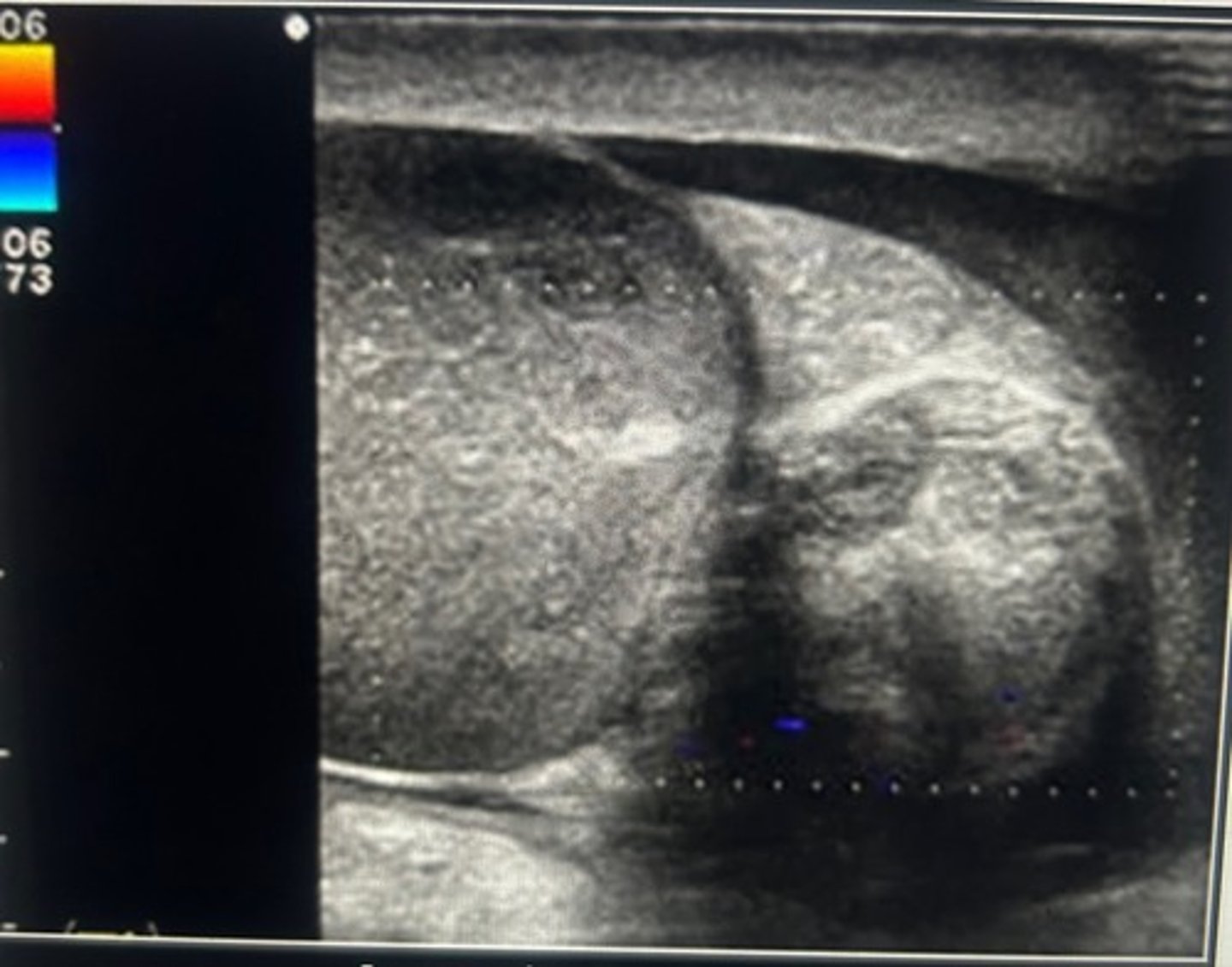 <p>The testicle an epididymis have abnormal echotexture an absence of normal internal flow. These findings are consistent with complete testicular torsion.</p>