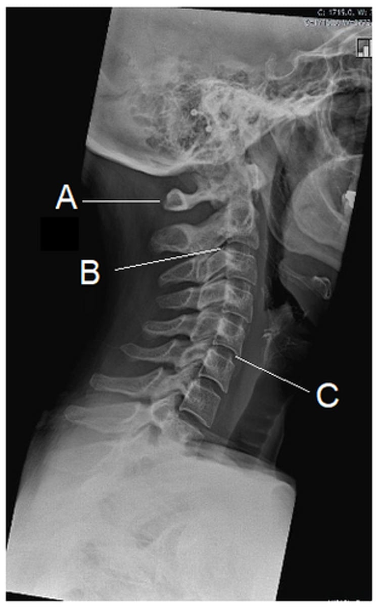 <p>Zygapopgyseal joint</p><p>3 multiple choice options</p>