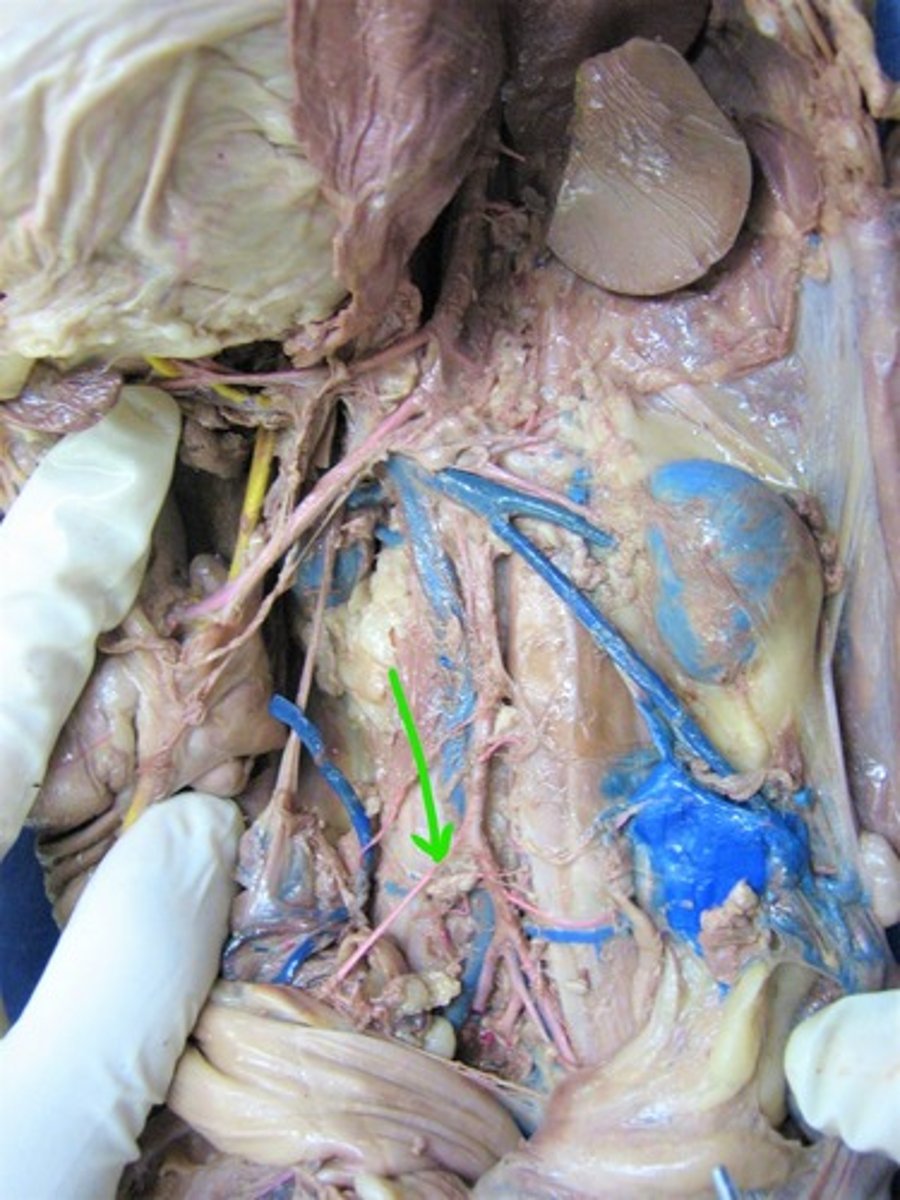 <p>identify this artery</p>