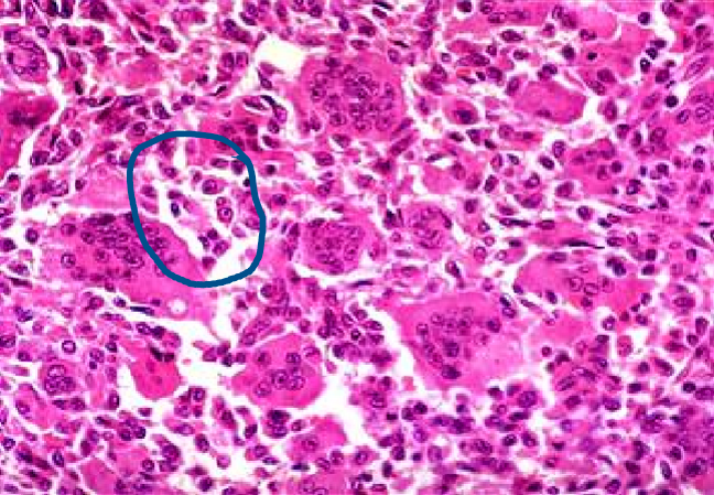 <p><strong><span style="color: red">uncommon benign but locally aggressive tumor</span></strong> that frequently <strong><span style="color: red">arises around the knee (distal femur &amp; proximal tibia)</span></strong></p><p>clinical presentations</p><ul><li><p>usually <strong><mark data-color="green">arises in individuals in their 20s - 40s</mark></strong></p></li><li><p><strong><mark data-color="blue">soap bubble appearance on X-ray</mark></strong></p></li><li><p><strong><mark data-color="blue">large, red-brown tumors that frequently undergo cystic degeneration</mark></strong></p></li><li><p>mostly composed of <strong><mark data-color="blue">uniform oval mononuclear cells and numerous osteoclast-type giant cells with 100 or more nuclei</mark></strong></p></li><li><p><strong><mark data-color="blue">neoplastic cells consist of proliferating mononuclear cells</mark></strong>, not giant cells</p></li></ul><p>treatment</p><ul><li><p><strong><mark data-color="purple">curettage, but 40% to 60% of cases recur locally</mark></strong></p></li></ul>