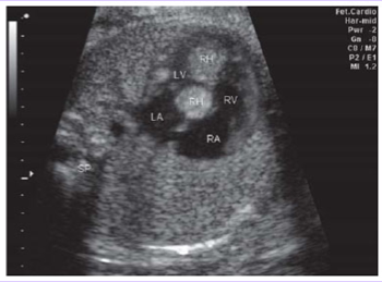 <p>Benign tumor of striated muscle.</p><p>Most common primary cardiac tumor in children.</p><p>Multiple in 90% of cases, but can be isolated.</p><p>Most frequently arise in the ventricular myocardium.</p>
