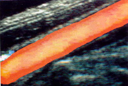 <p>Fast flow </p>