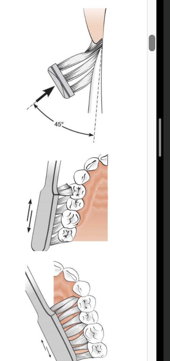 <ul><li><p>45 degrees to long axis of tooth at gingival margin </p></li><li><p>gentle vibratory pressure without dislodging bristles </p></li><li><p>continue for 20 strokes </p></li><li><p>sweep bristles towards occlusal edge </p></li><li><p>lift brush and move to adjacent teeth </p></li><li><p>brush occlusal surface </p></li></ul><p></p>