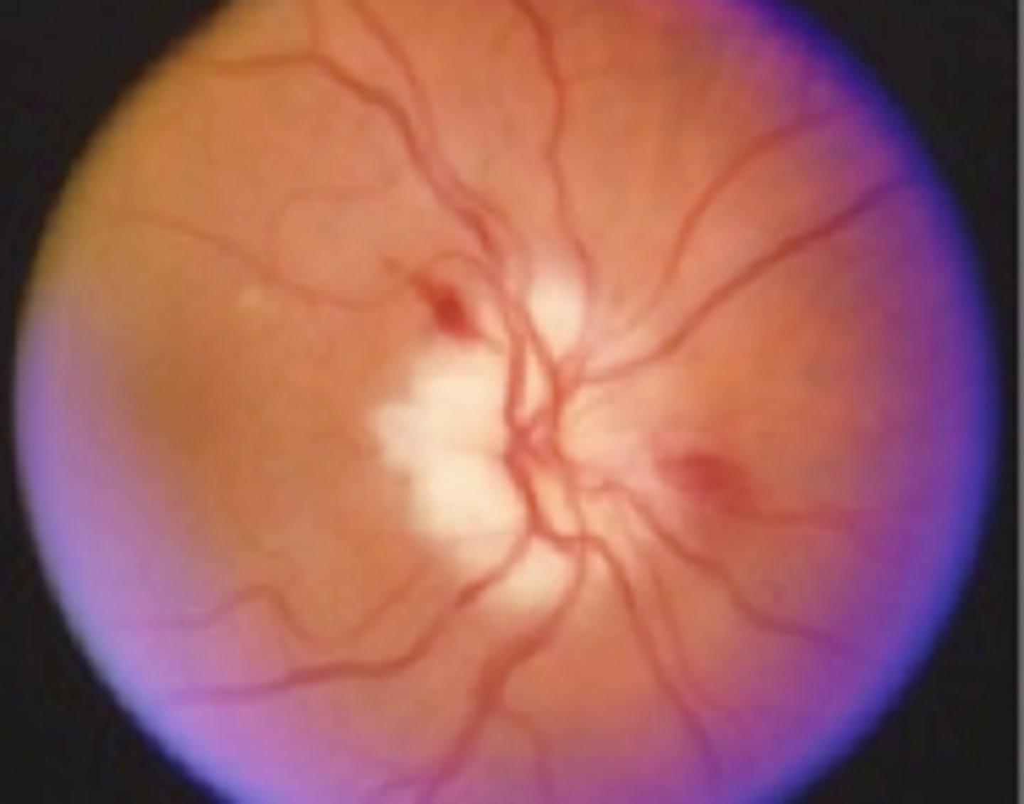 <p>Information for Condition:</p><p>Optic nerve ischemia due to overcrowding of nerve fibers and compromised vascular supply at the nerve head</p><p>Can be caused by Arteritis (Temporal Arteritis), embolus or thrombus</p>