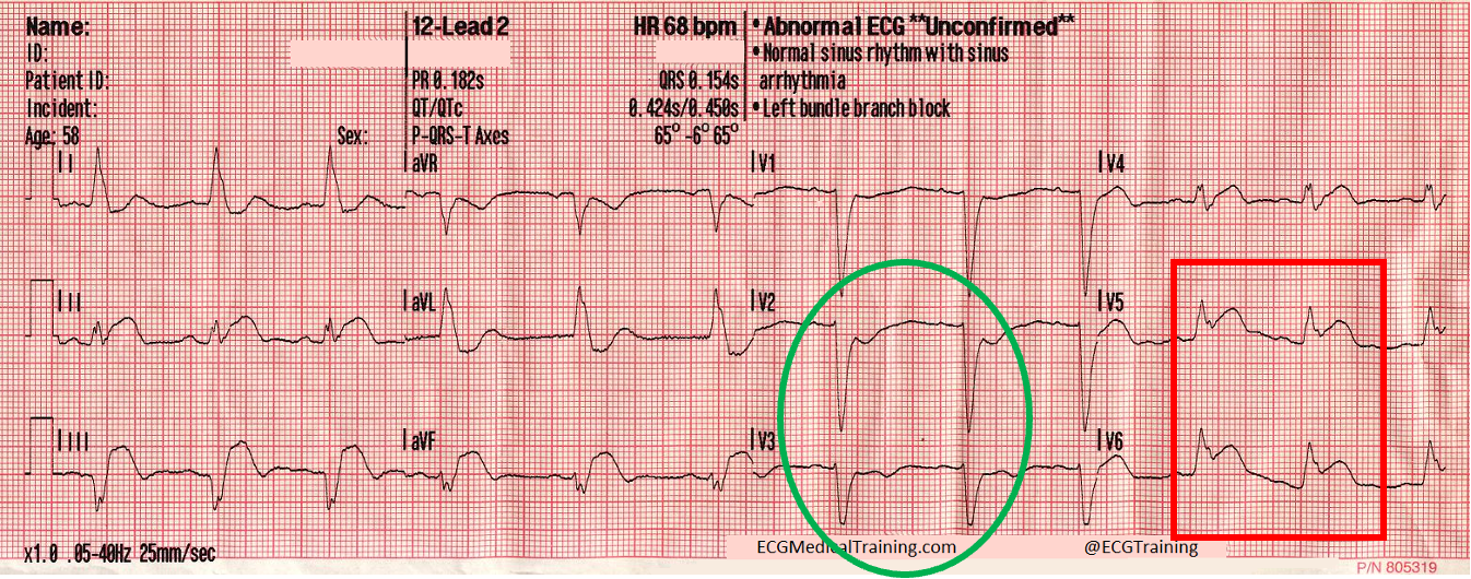 <p>what does this ECG show?</p>