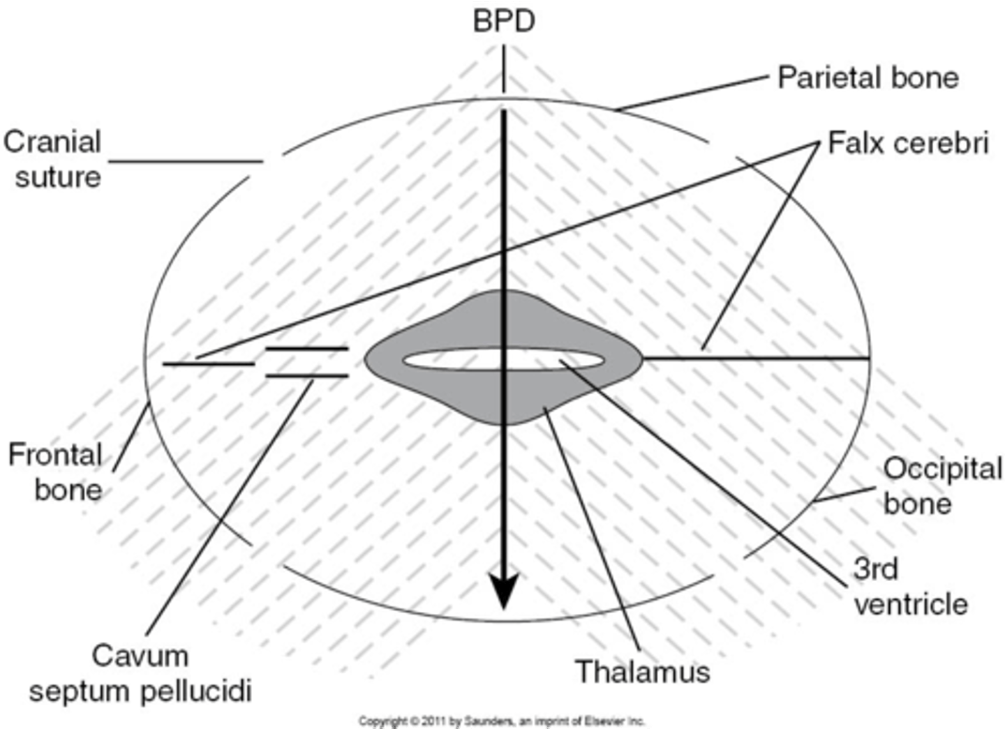 <p>3rd ventricle</p>