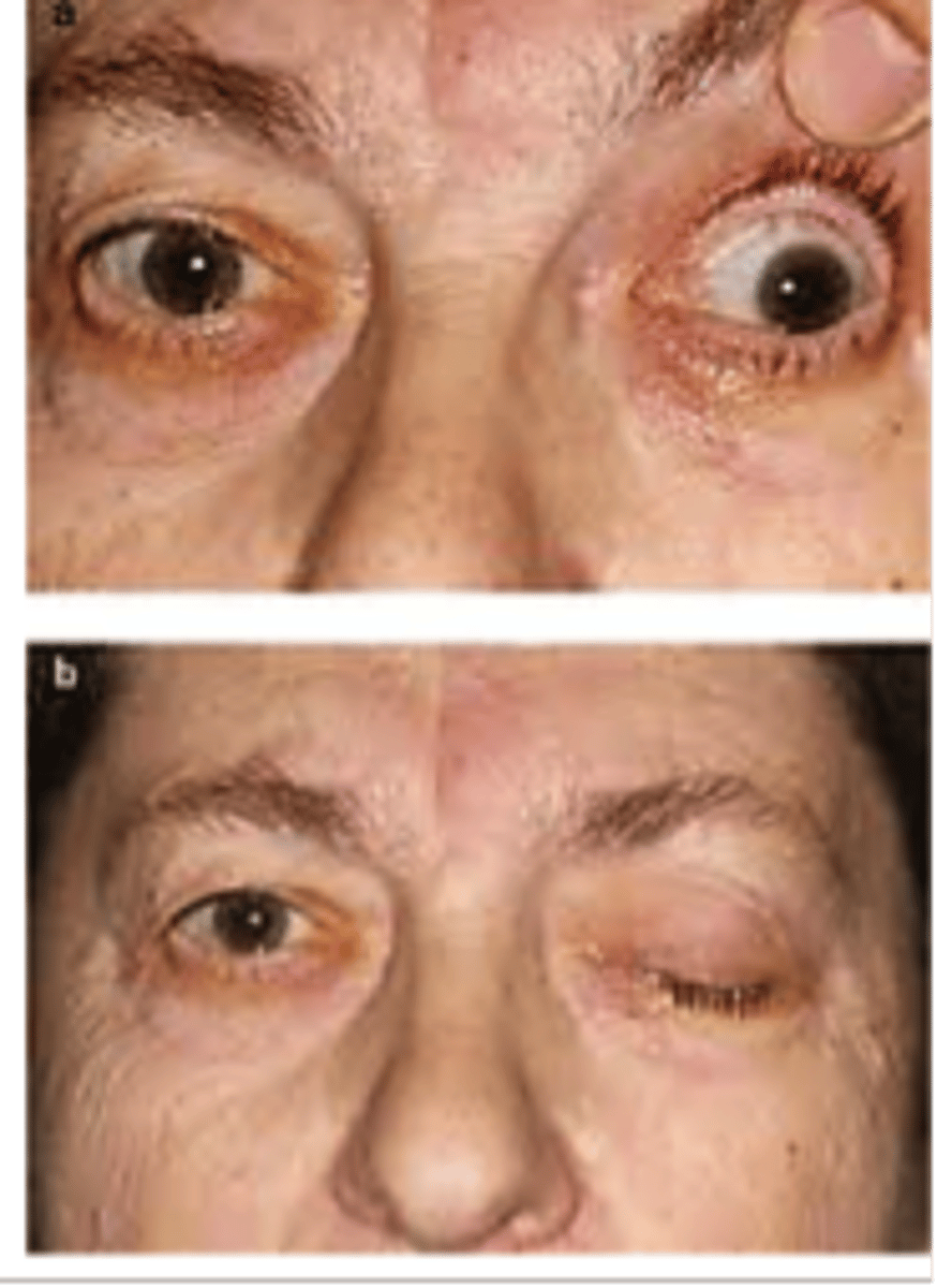 <p>smaller infarcts in the midbrain cause what symptoms?</p>