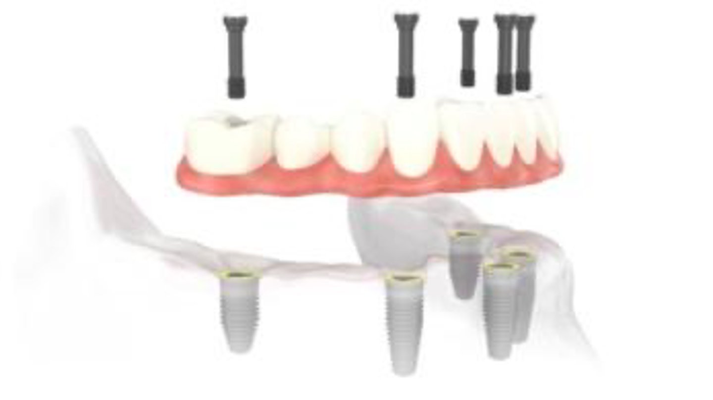 <p>Describe the retention and support for this denture</p>