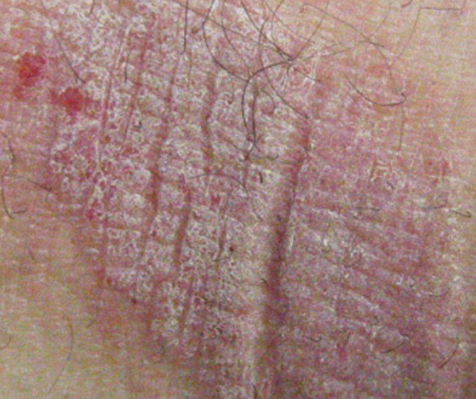<p>what type of lesion is depicted and when does it occur</p>