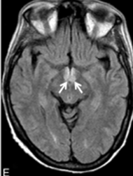 <p>clinical issues in mammillary bodies</p>