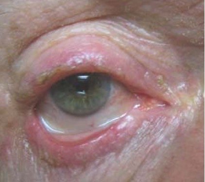 <p>Bacterial - staphylococcal —> most common cause of blepharitis</p><p></p><ul><li><p><strong><u>crusting/collarettes/scales</u></strong> - yellow deposits at base of lashes</p></li></ul><p></p><ul><li><p><mark data-color="red" style="background-color: red; color: inherit;">talengiectasia (dilated blood vessels)</mark></p></li></ul><p></p><ul><li><p><strong><mark data-color="red" style="background-color: red; color: inherit;">lash misdirection/loss</mark></strong></p></li></ul><p></p>