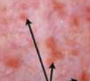 <p>minute hemorrahge below ski, small red dots </p>