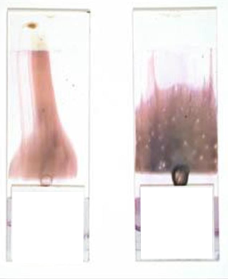 <p>What is this blood film appearance called and what is the cause/solution?</p>