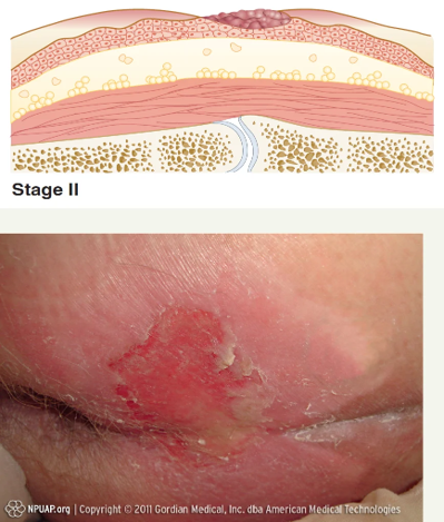 <p>involves partial-thickness loss of the dermis</p><p>No slough </p><p>Injury is open but shallow </p>