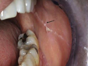 <p>similar to<span style="color: red;"><span> reticular papilla (Striae of Wickham)</span></span></p><p><span>a </span><span style="color: red;"><span>linear thickening of the buccal mucosa</span></span><span> (hyperkeratosis) that occurs along the occlusal plane</span></p><ul><li><p><strong>clinical consideration</strong></p><ul><li><p><span style="color: red;">biopsy</span> may be warranted in the presence of persistent trauma or unresolving ulceration</p></li></ul></li></ul><p></p>