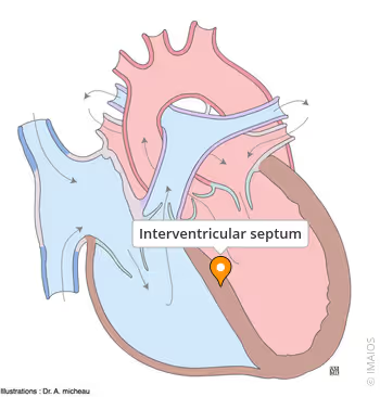 <ul><li><p>modification of amphibian heart from fish heart (adapted to land)</p></li></ul><p>Both reduce mixing of oxygenated/deoxygenated blood. separates right and left ventricles</p><ul><li><p><u>Partial septum:</u> dipnoans, sirens</p></li><li><p><strong><u>Trabeculae</u></strong>: most amphibians (ridges inside ventricle)</p></li></ul><p></p>