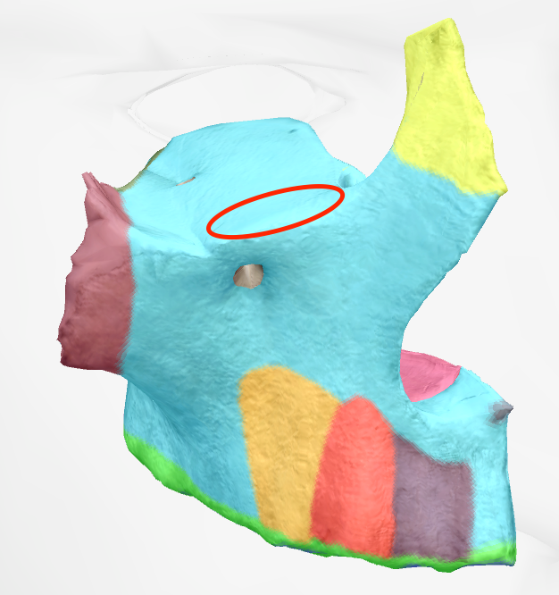 <p>border anterior of orbital surface on maxilla </p>