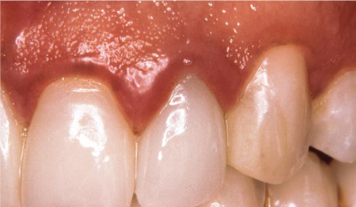 <p>underneath the gingiva</p>