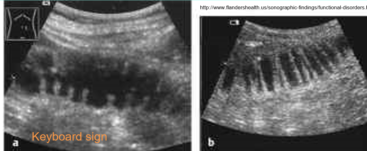 <p><span>•valvulae conniventes seen as linear structures closely spaced along wall of duodenum & jejunum</span></p>