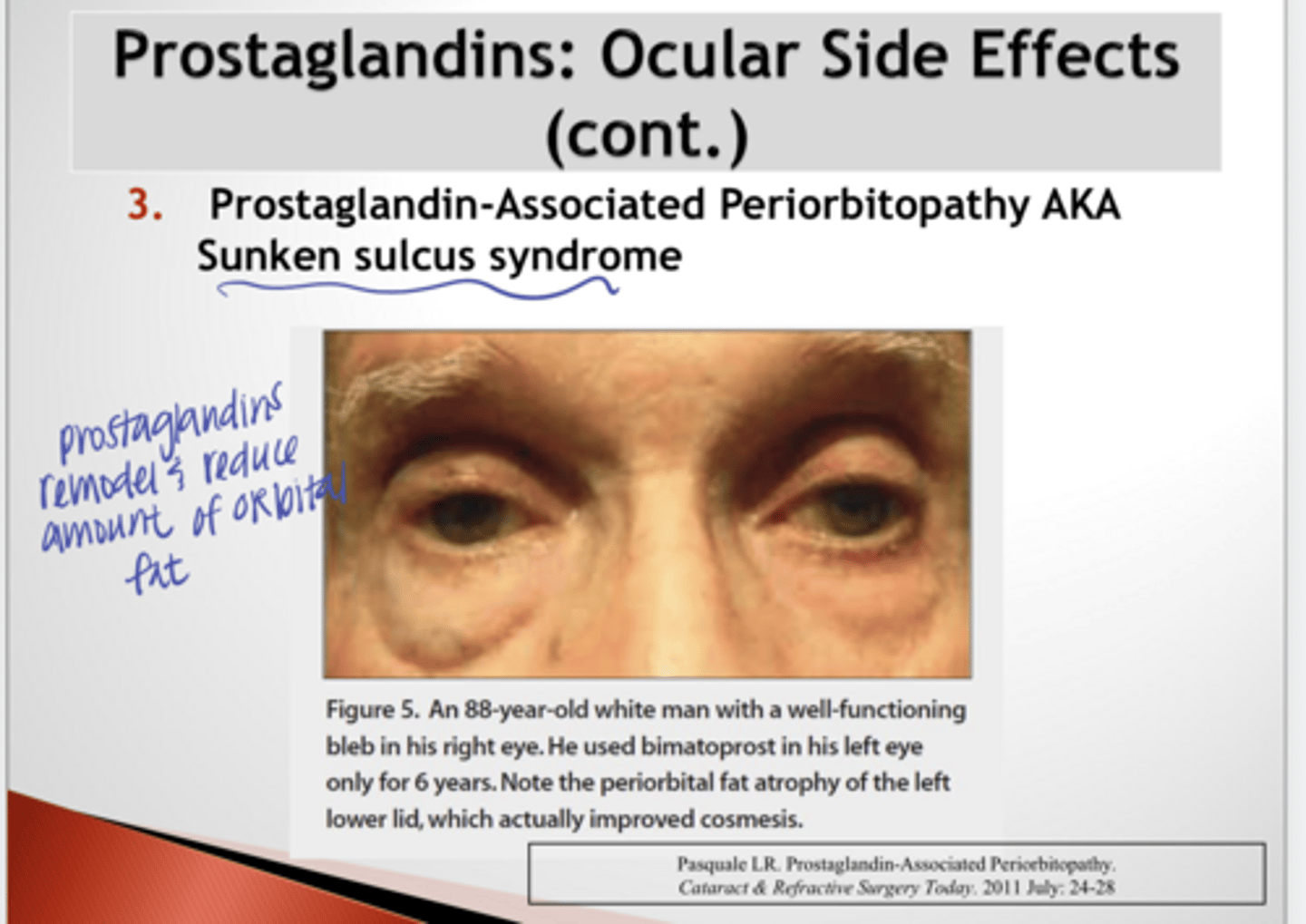 <p>What are the characteristics of Prostaglandin-Associated Periorbitopathy (Sunkun Sulcus Syndrome) secondary to prostaglandin use?</p>