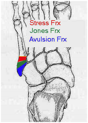 <p>fx @ prox 5th metatarsal </p><p></p>