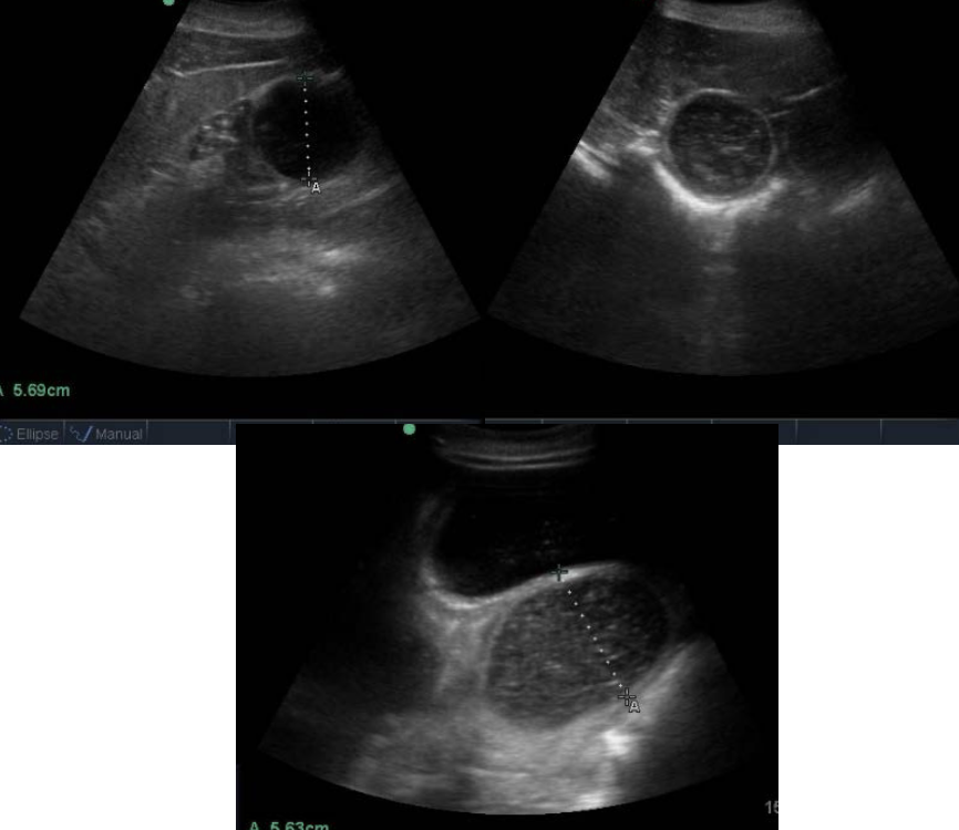 <p>distended, amotile small intestine. may see localized thickening of SI wall</p><p>usually 2 populations- one distended, other is normal</p>