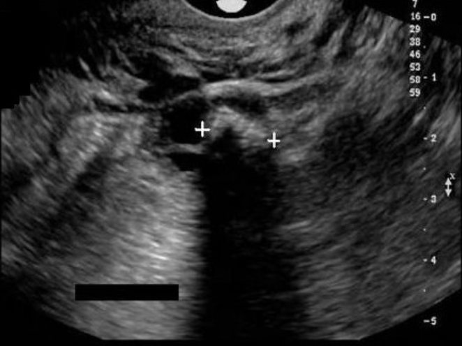 <p>26 yo female has pelvic pain + prior <strong>left oophorectomy </strong>due to cyst formation. the calipers are measuring a large echogenic mass with</p><p>a) dirty shadowing, most likely large fecalith in bowel</p><p>b) dirty shadowing, most likely an obstruction in the bowel</p><p>c) posterior shadowing, most likely a dermoid cyst</p><p>d) posterior shadowing, most likely a chocolate cyst</p>