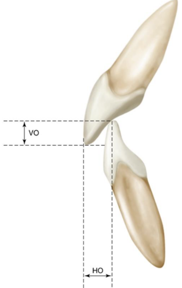 <p>anterior guidance examined in the vertical plane, 3mm is normal</p>