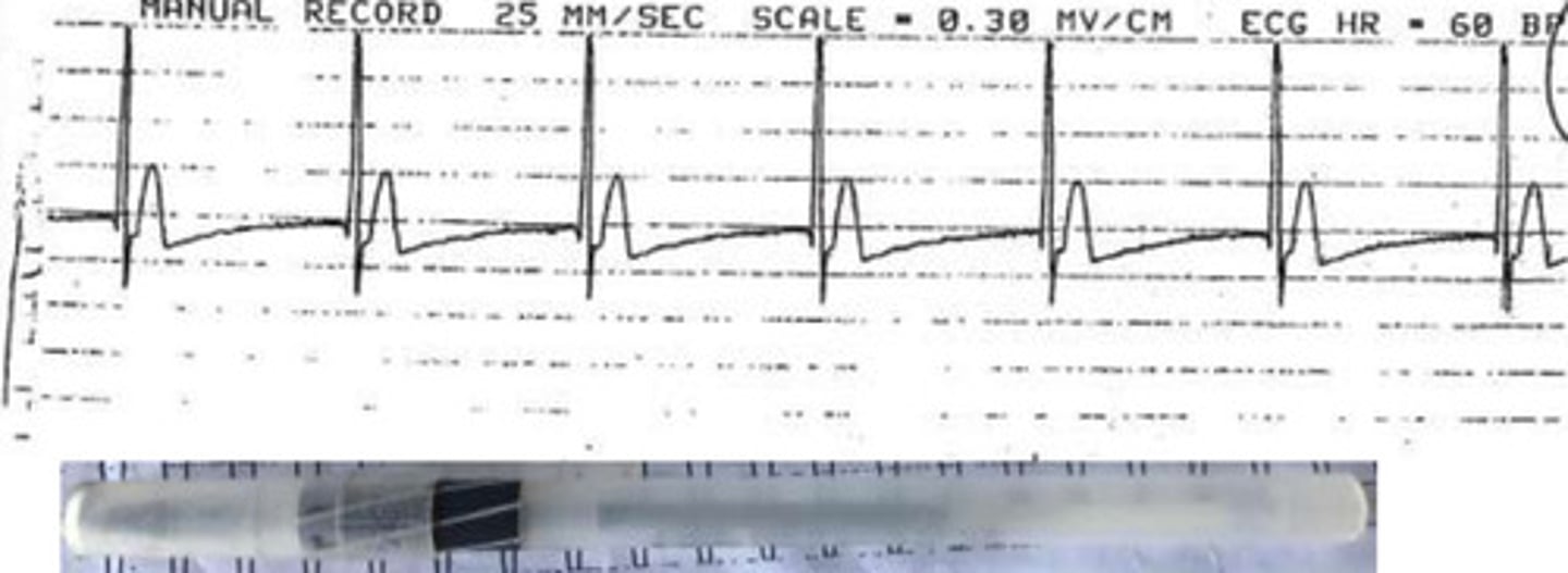 <p>What arrhythmia is this?</p>