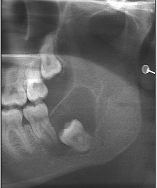 <p>Central dentigerous cyst</p>