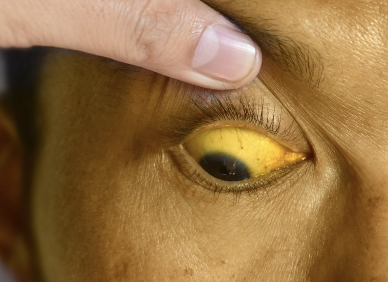 <p>Abnormal Skin Pigmentation Finding</p><ul><li><p>In light- and dark-skinned people is characterized by <strong>yellow</strong> skin tones, from pale to pumpkin, particularly in the sclera, oral mucosa, palms, and soles</p></li><li><p>Associated with <strong>hepatic dysfunction</strong></p></li><li><p>Usually found in skin and/or sclera (for African-American patients)</p></li><li><p>Found in mucous membranes</p></li><li><p>Some with jaundice may have Hepatitis A, C which can infect other people through blood, sexual contact, and food</p></li></ul><p></p>