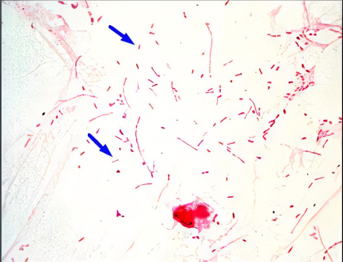 <p><strong>Lab differentiation:</strong></p><ul><li><p><strong>Gram stain:</strong> Small Gram-negative coccobacilli.</p></li><li><p><strong>Culture:</strong> Requires <strong>chocolate agar</strong> with both X factor (hemin) and V factor (NADāŗ) for growth. Wonāt grow on standard blood agar unless āsatellitingā near Staphylococcus aureus (which provides V factor).</p></li><li><p><strong>Tests:</strong> Catalase-positive, oxidase-positive. Serotyped by capsule polysaccharides (type b is most virulent).</p></li></ul><p><span data-name="woman_health_worker" data-type="emoji">š©āā</span> <strong>Patient scenario:</strong><br>A 3-year-old unvaccinated child develops fever, drooling, and difficulty breathing. Examination shows inspiratory stridor, and lateral neck X-ray reveals a <strong>āthumb signā</strong> suggesting epiglottitis. Throat culture on chocolate agar confirms the pathogen.</p><p><span data-name="clipboard" data-type="emoji">š</span> <strong>Details:</strong><br>(A) Classification: <strong>Gram-negative coccobacillus.</strong><br>(B) Disease: Causes meningitis, epiglottitis, pneumonia, otitis media, and sinusitis.<br>(C) Identification/Diagnosis: Chocolate agar growth, requirement for X and V factors, serotyping for capsule, PCR or antigen detection in CSF.<br>(D) Treatment/Prevention: Ceftriaxone for serious infections; rifampin prophylaxis for close contacts. Prevention with <strong>Hib conjugate vaccine</strong>.<br>(E) Unique Epidemiology & Lab Safety: Spread by respiratory droplets. Encapsulated strains (especially type b) cause invasive disease. BSL-2 handling in labs.</p>