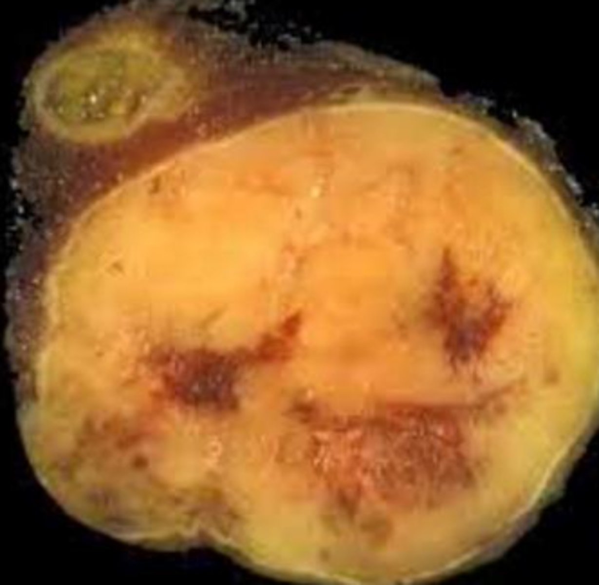 <p>highly necrotic and hemorrhagic solid mass; tan to brown cut</p><p>HUGE</p>