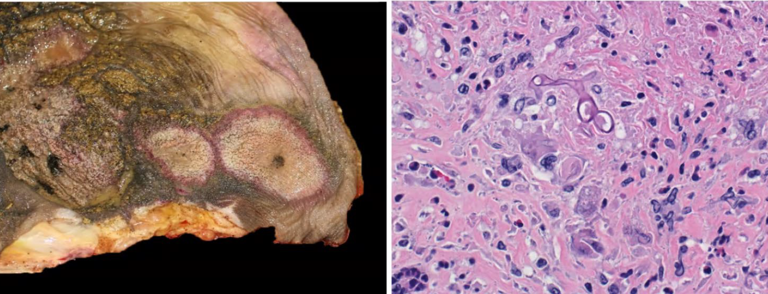 <p>What is the etiology?</p><p>A-Mucor spp.</p><p>B-Aspergil/us spp .</p><p>C-Histoplasma spp.</p><p>C- Coccidioides spp.</p>