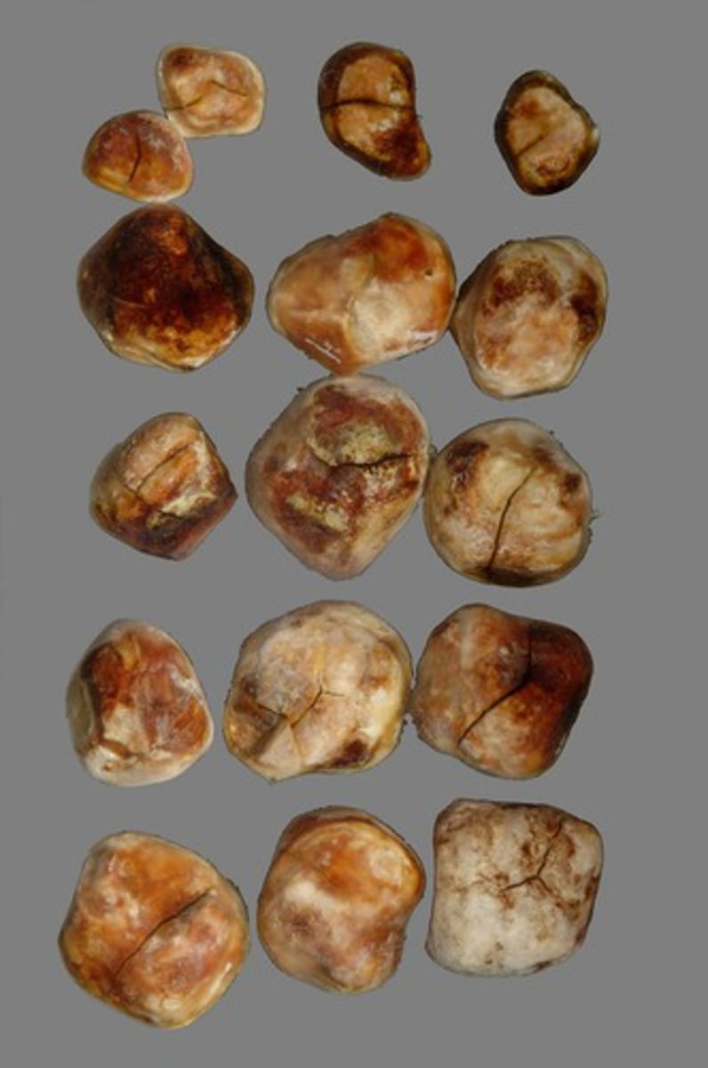 <p>cálculos biliares</p>