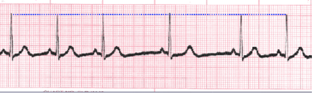 <p><strong>Sinus Arrhythmia/Dysrhythmia</strong></p><p>-Rate, intervals, and morphology are normal</p><p>-Rhythm is _________</p><p>-R-R ________ vary by _ or more intervals, switching between longer and shorter periods of time </p>