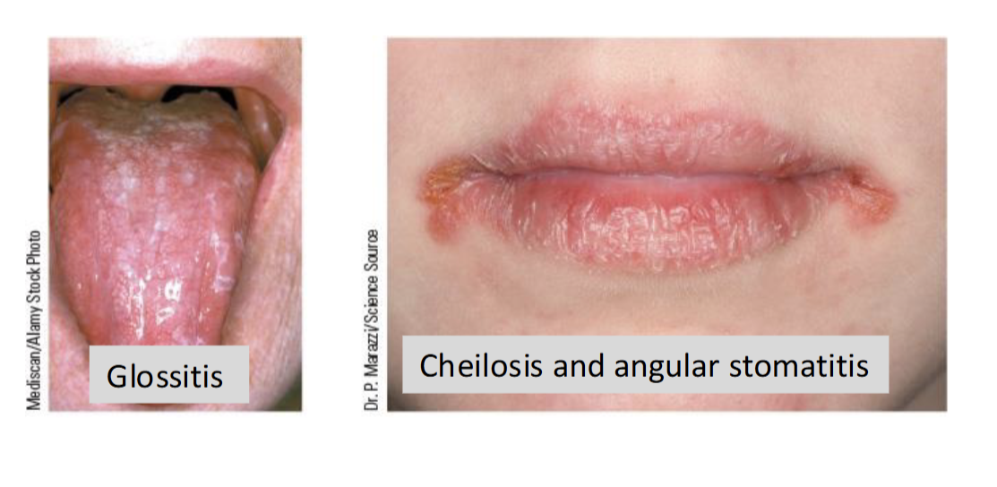 <p>Rare and typically associated with broader nutrient deficiencies & malnutrition</p><ul><li><p>Causes arbioflavinosis: inflammation of membrane of the mouth, skin, eye, and GI tract</p></li></ul><p></p>