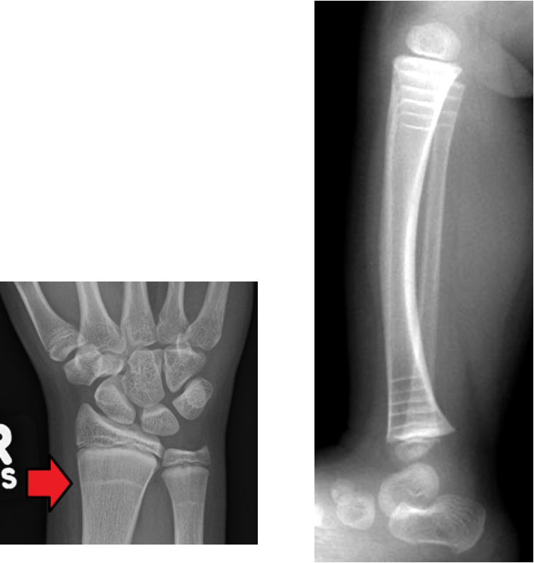 <p>due to period of arrested growth= perhaps sickness or malnutrition</p><p>occur in distal tibia</p><p>appear as radiopaque transverse line in metaphysis of long bones, indicator reflecting stress conditions such as dz or malnutrition</p>