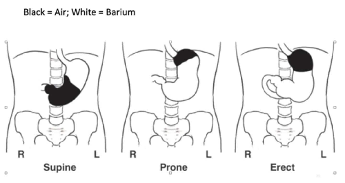<p>fundus is located posteriorly so barium goes to fundus</p>