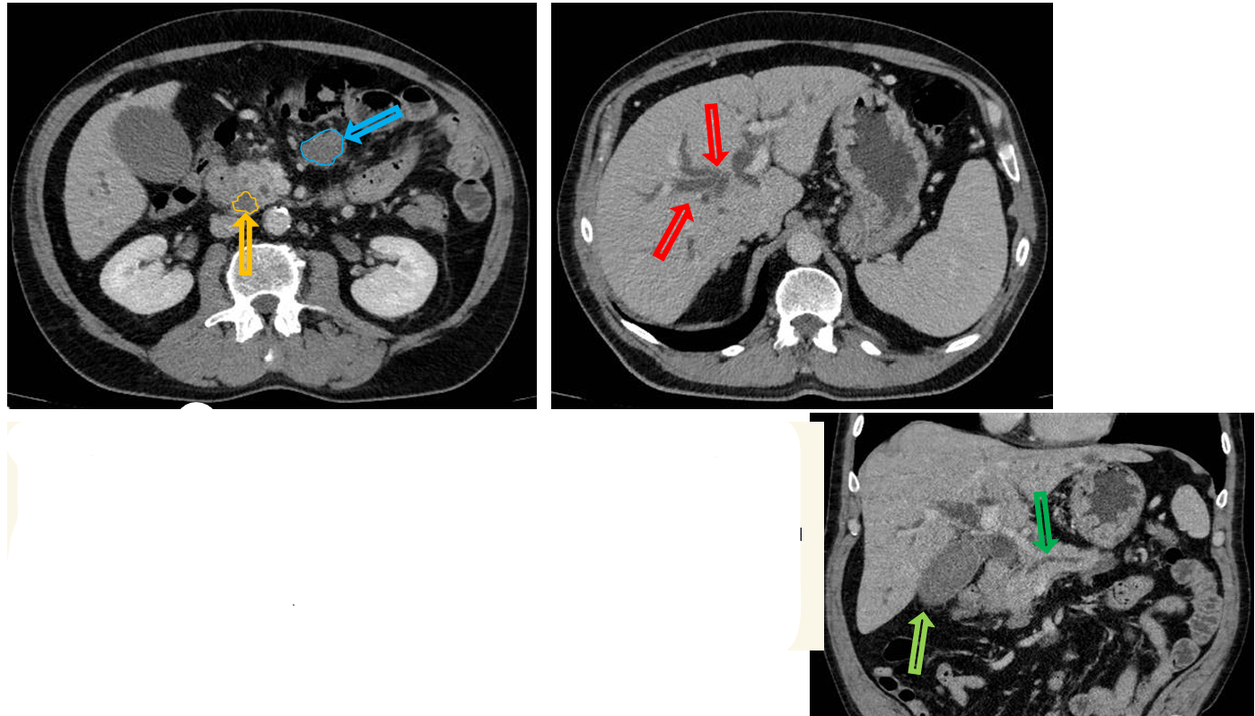 <p>Patient history: fatigue, weight loss and jaundice in a middle-aged male patient </p><p>Modality: contrast enhanced CT (venous phase), left and right – axial planes, bottom – coronal plane reconstruction (iv. iodine-based contrast agent) </p><p>Region: upper abdomen </p><p>Radiologic sign: mass in the pancreas head that is hypodense in the venous phase (yellow area); dilated hypodense intrahepatic bile ducts (red arrows, normally not visible), gallbladder distended with fluid, hydropic (light green arrow), pancreatic duct also dilated due to the obstruction (dark green arrow). Enhancing soft tissue mass with lobulated margin in the mesenterium (blue arrow). </p><p>Diagnosis: pancreas adenocarcinoma with regional lymphadenopathy, distended bile ducts and pancreatic duct</p>