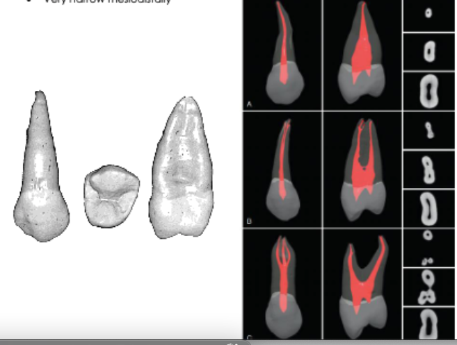 <p>very broad BL<br>very narrow MD</p>