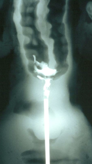 <p>body of the uterus (between the internal os of the cervix and the bifurcation)</p>