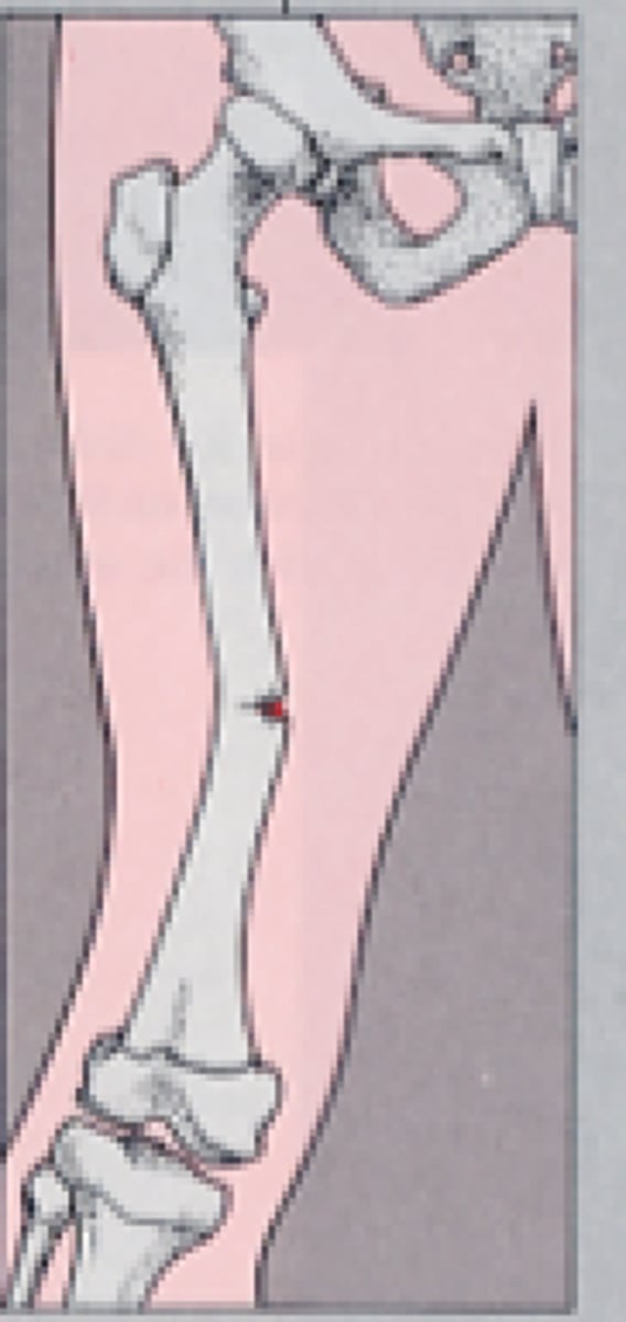 <p>a slight fracture in a bone that appears as a slight fissure or hairline in an x-ray; usually the simplest type of fracture to reset and splint; often seen in children due to high cartilage matrix of the bones</p>