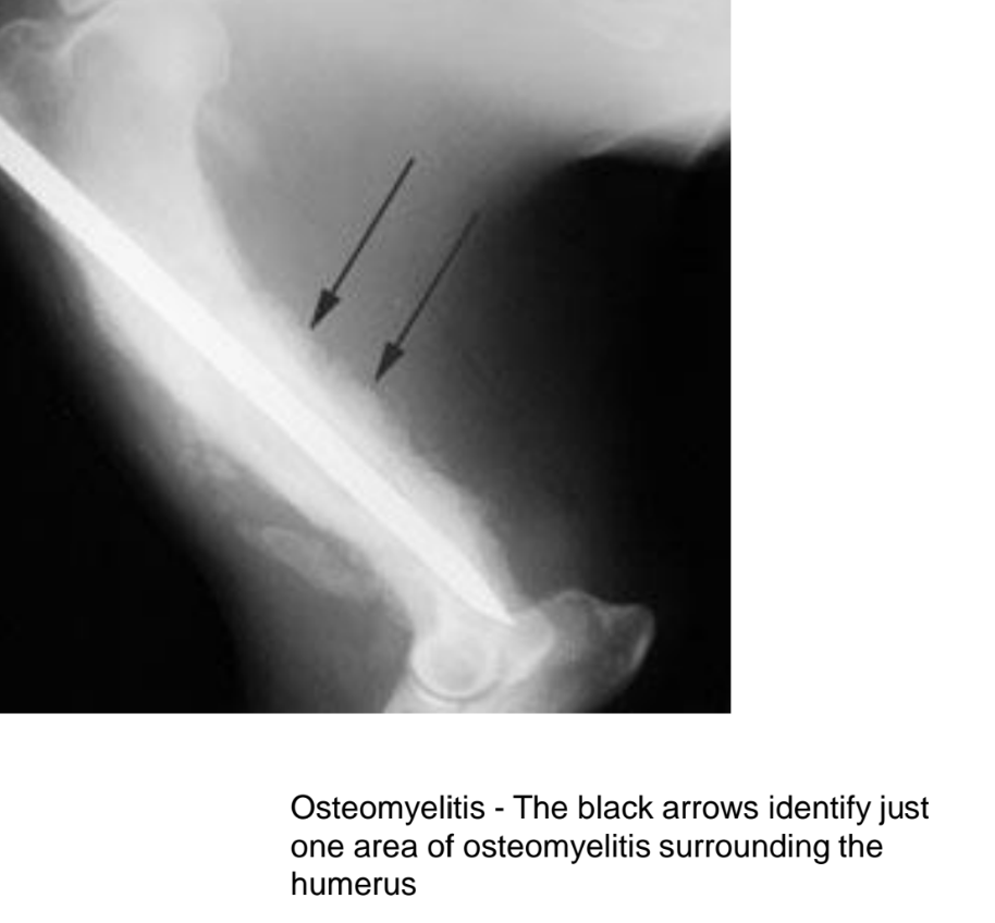 <ul><li><p><strong>serious infection of the bone</strong>, often caused by bacteria, fungi → inflammation and necrosis.</p></li><li><p>can<strong> result from open fractures, surgery, or spread from nearby infections. </strong></p></li><li><p><strong>symptoms: </strong>localized pain, swelling, fever, chills</p></li><li><p>X-ray appearance - depends on whether it is acute or chronic:</p><ul><li><p><strong>acute</strong>: indefinite image, signs of inflammation (swelling) and possible presence of gas. </p></li><li><p><strong>chronic:</strong> periosteal reaction, radiographic changes like increased radiopacity in marrow due to presence of sclerotic bone or sequestrum, which are avascular segments of bone that have died due to infection. </p></li></ul></li></ul><p></p>