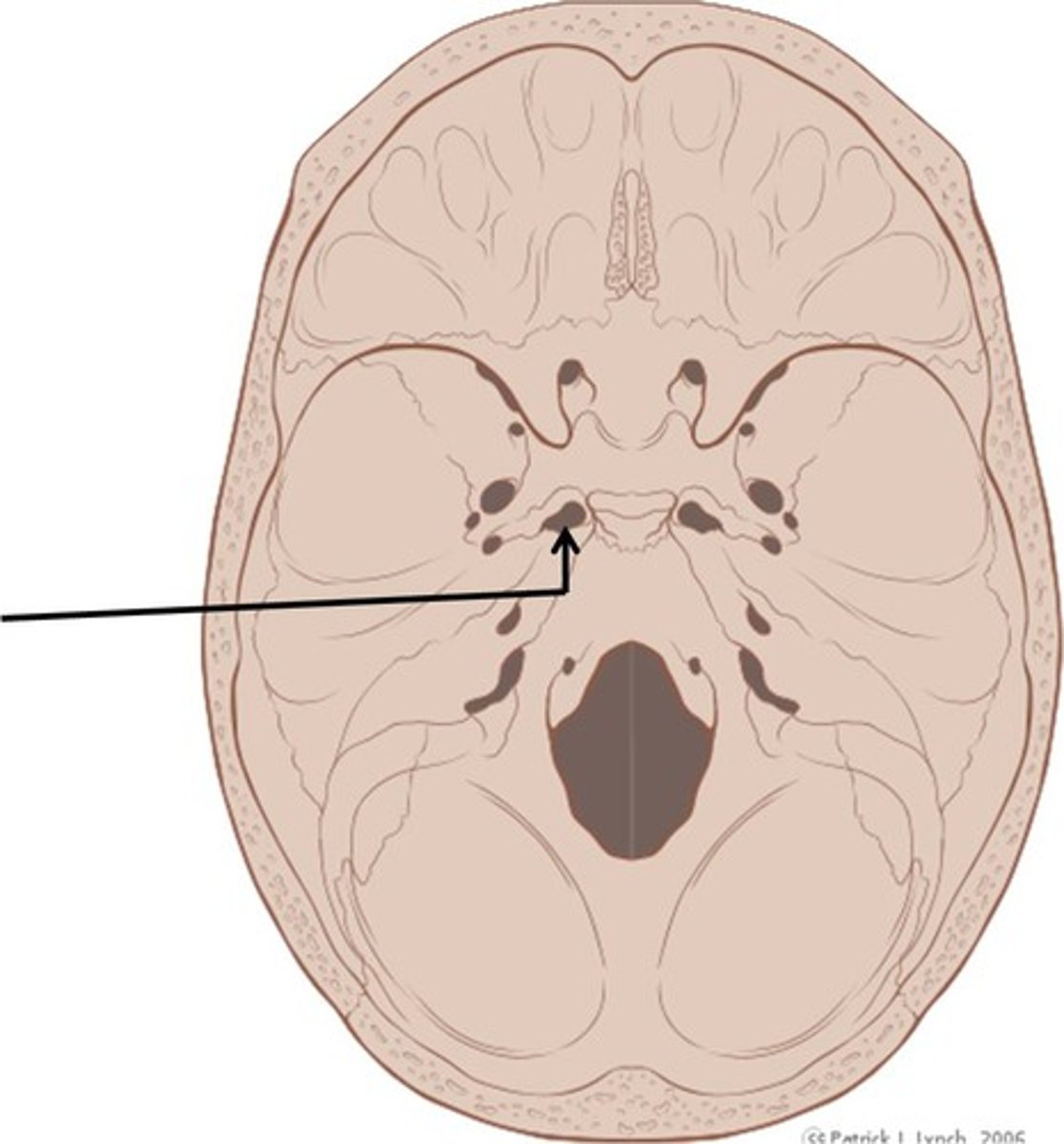 <p>(Temporal)</p><p>Almost completely closed by cartilage in the living person but forms a jagged opening in dried skulls</p>