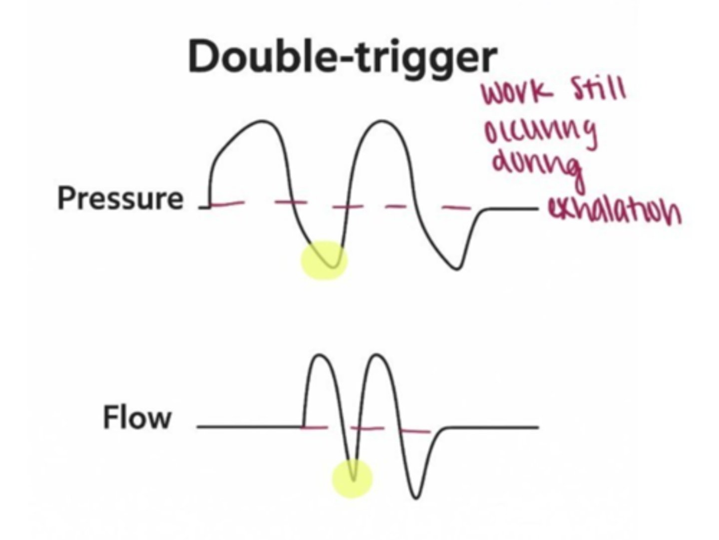 <p>Pt tries to breathe longer or deeper than vent setting</p><p>-cycles to expiratory phase while pt makes insp effort</p><p>To fix: increase i-time or switch mode (PSV,assist)</p>