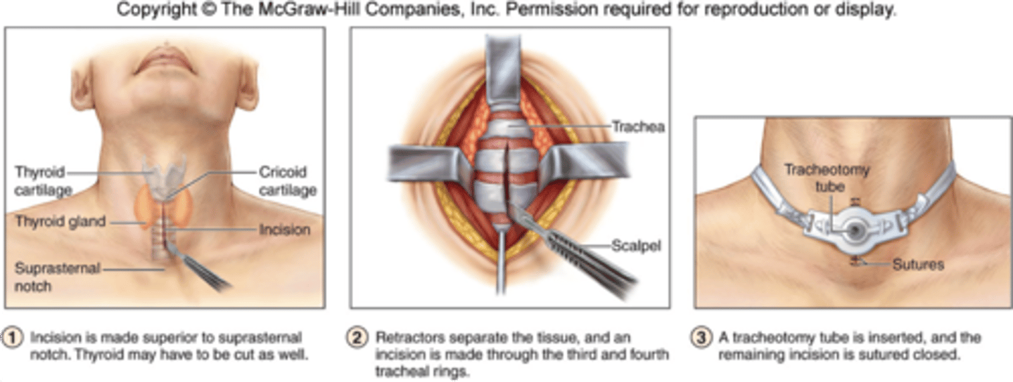 <p>Procedure to provide oxygen to lower respiratory system when it cannot make it through the larynx</p>